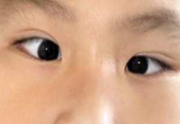 Mắt lé là gì? Nguyên nhân và cách điều trị cần biết