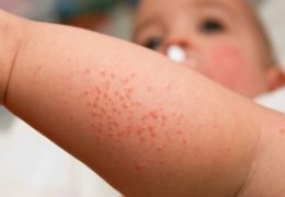 Nguyên nhân và triệu chứng của bệnh sốt phát ban bạn nên biết