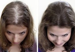 Mách bạn 4 cách trị rụng tóc tại nhà cực hiệu quả
