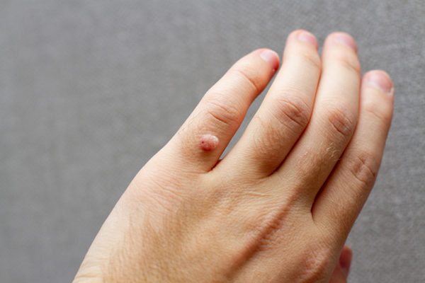 Mụn có thường phổ biến xuất hiện ở tay và chân.
