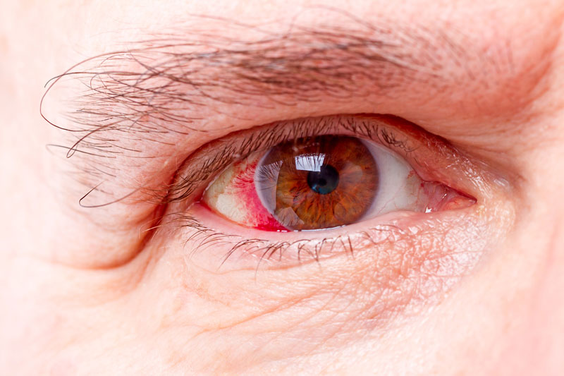 Các bệnh về mắt nên sử dụng nước muối sinh lý