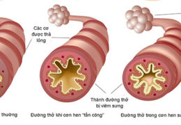 10 yếu tố khiến hen phế quản nặng lên